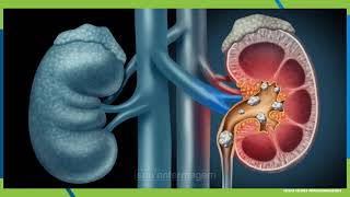 Patologias Sistema Urinário [upl. by Eimot]