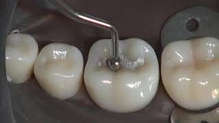 Class I Amalgam Preparation amp Restoration  Operative Dentistry [upl. by Gagne]