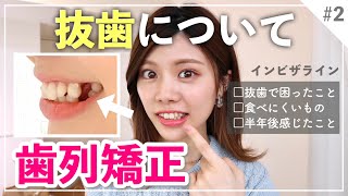 【歯列矯正②】現在の様子と抜歯について🦷痛い？後悔する？抜歯で困ったこと・食べにくいもの【矯正あるある】 [upl. by Amalea527]