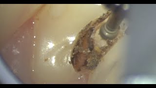 Caries Removal and indirect pulp capping [upl. by Curran]