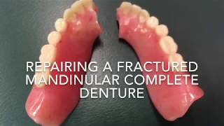 Repairing a fractured denture [upl. by Villiers527]