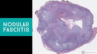 Esofagitis Causas síntomas y tratamiento [upl. by Mahau]