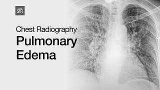 Chest Radiography Pulmonary Edema [upl. by Kester873]