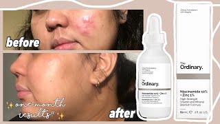 How to use The Ordinary Glycolic Acid 7 Toning Solution and Niacinamide 10  Zinc 1 [upl. by Laurie]