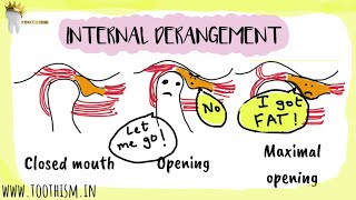 INTERNAL DERANGEMENT Anterior Disk Displacement  Temporomandibular Joint [upl. by Worrell]