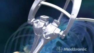 Medtronics Sextant  Minimally Invasive Spinal Fusion [upl. by Ammamaria52]