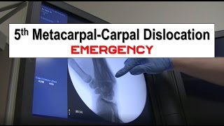 Fifth Metacarpal Dislocation and Reduction Emergency [upl. by Oicaroh375]