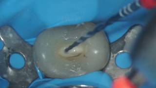 VDW Dental · Grande amp Plotino RECIPROC blue  Step by step preparation clinical video [upl. by Antonius]