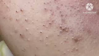 Super blackheads HoangMySpa24 [upl. by Nilsoj]