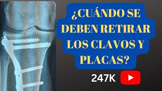 ¿CUÁNDO SE DEBEN RETIRAR LOS MATERIALES DE OSTEOSINTESIS [upl. by Notwen492]