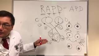 RAPD Relative Afferent Pupillary Defect MarcusGunn pupil [upl. by Yhotmit]