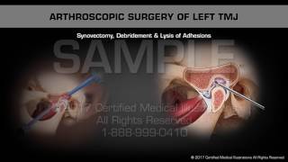 Arthroscopic Surgery of Left TMJ [upl. by Latvina]