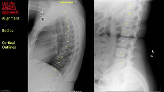 Introduction to Spine Radiographs [upl. by Evey183]