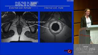 GI  Perianal fistula disease  All you need to know 1 [upl. by Htilil290]