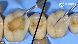 Step by Step Dental Filling Cavity Filling  Tooth Filling Cusp BuildUp of a Molar [upl. by Anivlis927]