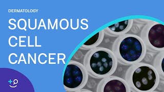 Squamous Cell Cancer Dermatology [upl. by Hajan]