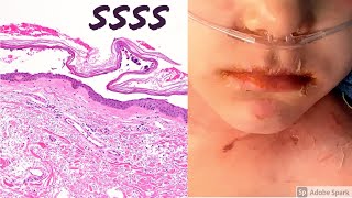 Staphylococcal scalded skin syndrome SSSS 5Minute Pathology Pearls [upl. by Reivax200]