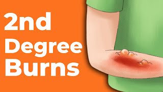 2nd Degree Burns How to Treat Them  Wound Care OC [upl. by Fisch777]