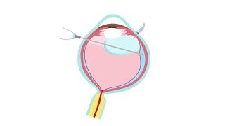 Retinal Detachment Treatment—Pars Plana Vitrectomy [upl. by Roselani]