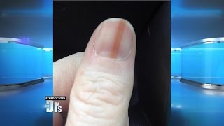 Melanoma on Your Nail [upl. by Dorthea]