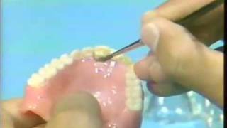 Replacing a Broken Complete Denture Tooth [upl. by Bastien328]