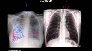 Pneumonia Imaging [upl. by Islean]