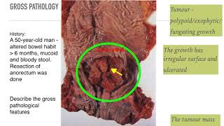 Understanding NonSmall Cell Lung Cancer [upl. by Ibson]