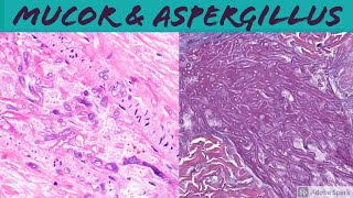 Mucormycosis amp Aspergillosis Angioinvasive Fungal Infection [upl. by Torrin836]