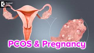 What happens if I have PCOS and I get pregnant  Dr Bala R [upl. by Esyahc]