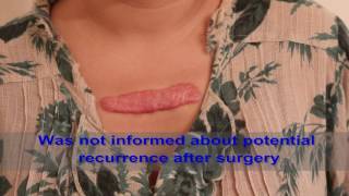 Chest Keloids  Mistakes to Avoid [upl. by Coveney872]