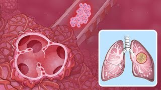 Overview of Cutaneous Squamous Cell Carcinoma [upl. by Louanna]