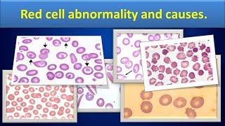 Red cell abnormality and causes [upl. by Elora659]