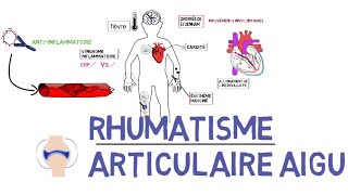 Rhumatisme articulaire aigu RAAde A à Z [upl. by Poler]