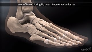 InternalBrace™ Spring Ligament Augmentation Repair [upl. by Attecnoc726]