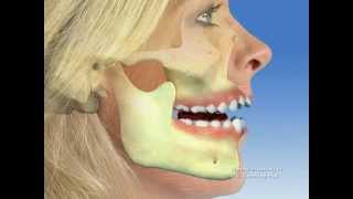 TMJ  Temporomandibular joint dysfunction [upl. by Rodman]