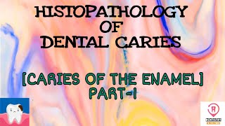 HISTOPATHOLOGY OF DENTAL CARIES  CARIES IN THE ENAMEL PART1 [upl. by Nahem]