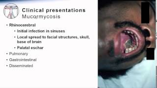 Mucormycosis [upl. by Drofhsa]