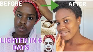 How I How i BRIGHTENED MY SKIN IN 6 DAYS REALISTIC and Natural way to reduce hyperpigmentation [upl. by Kary]