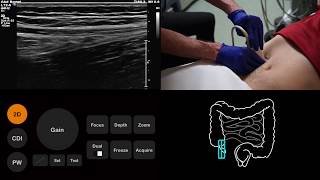 Ultrasound Tutorial AppendixAppendicitis  Radiology Nation [upl. by Glenn]