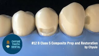 ChyuieThuth 12 B Class 5 Composite Prep and Restoration [upl. by Barna]