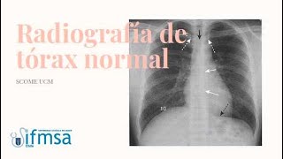 Radiografía de Tórax Normal [upl. by Anaitsirhc27]