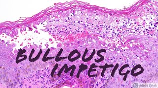 Bullous Impetigo vs Staphylococcal Scalded Skin SSSS 5Minute Pathology Pearls [upl. by Eiluj549]