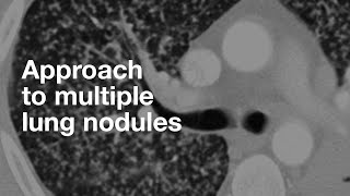 Understanding NonSmall Cell Lung Cancer [upl. by Yraunaj921]