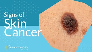 Skin Cancer Screening  Symptoms Types amp Warning Signs [upl. by Sedgewake]