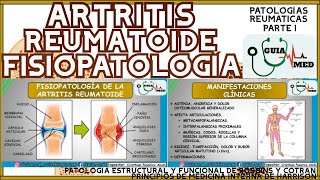 ARTRITIS REUMATOIDE FISIOPATOLOGÍA  GuiaMed [upl. by Land28]