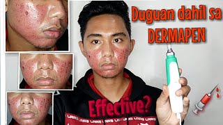 DERMAPEN BEFORE AND AFTER TREATMENT HONEST REVIEW Dermapen VS Dermaroller Dermapen Tutorial At Home [upl. by Nerrad]