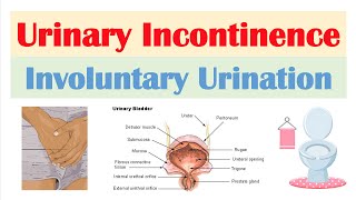 Urinary Incontinence Stress Urge Overflow amp Functional  Causes Symptoms Diagnosis Treatment [upl. by Wurtz196]