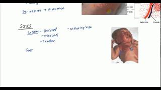 Staphylococcal Scalded Skin Syndrome SSSS and Bullous Impetigo [upl. by Edwyna]