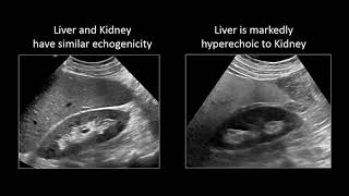 GI Imaging  Hepatic Steatosis and Cirrhosis [upl. by Trotter697]