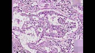 Histopathology Lung Adenocarcinoma [upl. by Erle779]